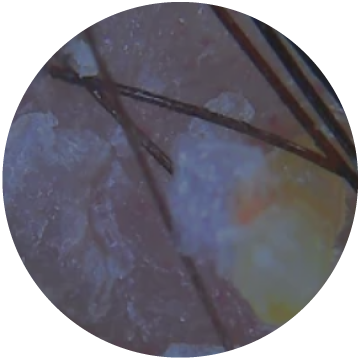 Clogged Hair Follicles