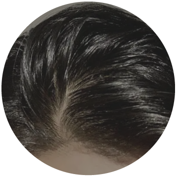 Excessive Oil Production