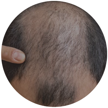 Lack of Scalp Awarness